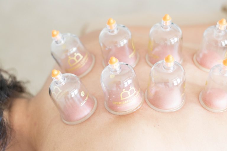 cupping therapie kine roeselare